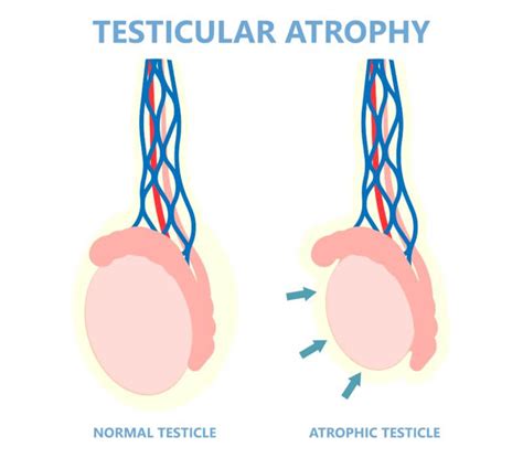 saggy nuts|Sagging testicles: Causes, treatments, and when to see a doctor.